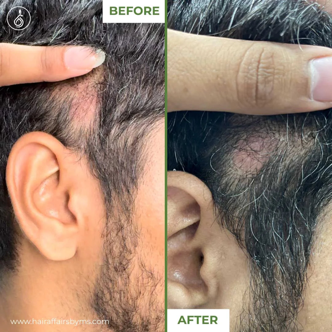 Hair Regrowth Bundle