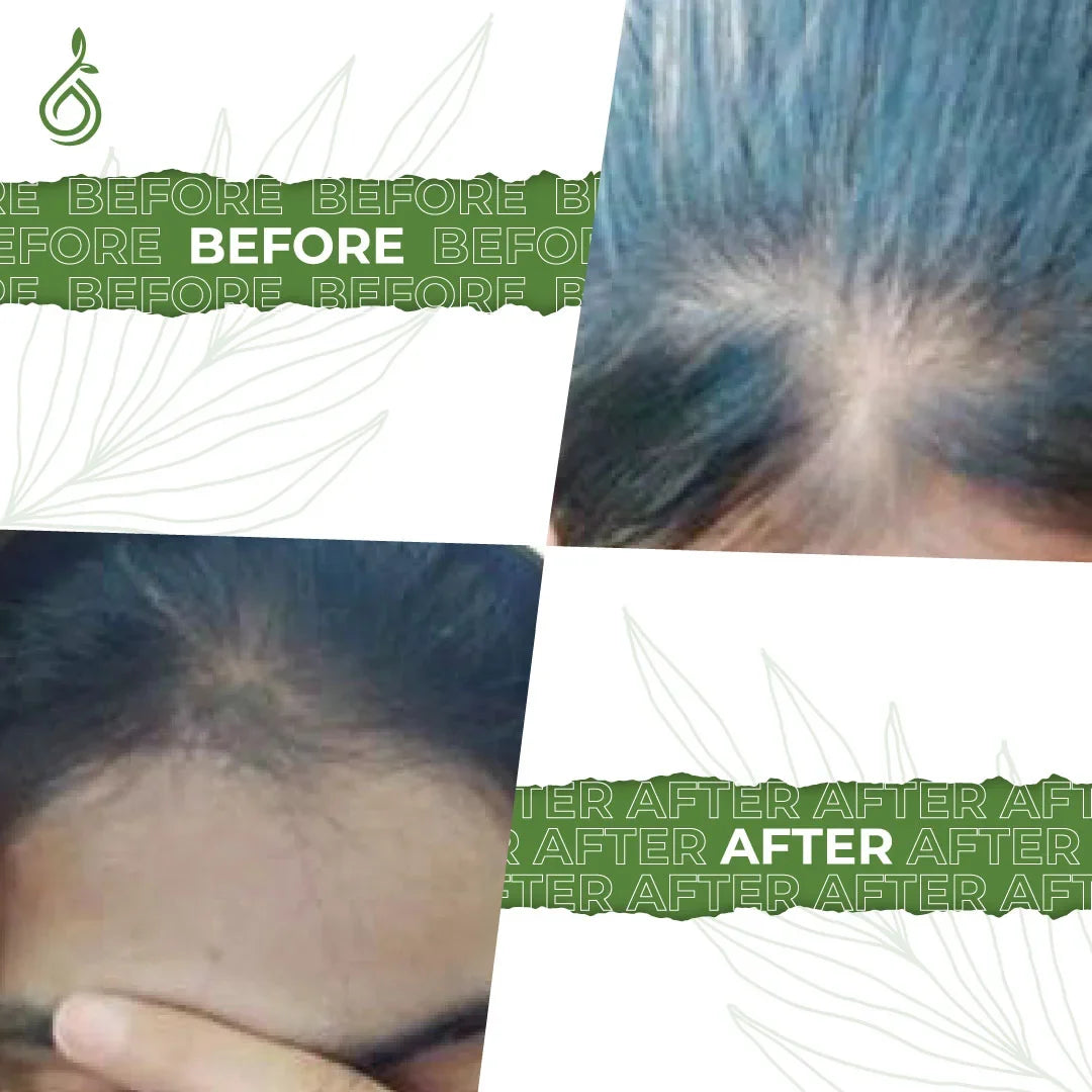 Hairfall Hairgrowth