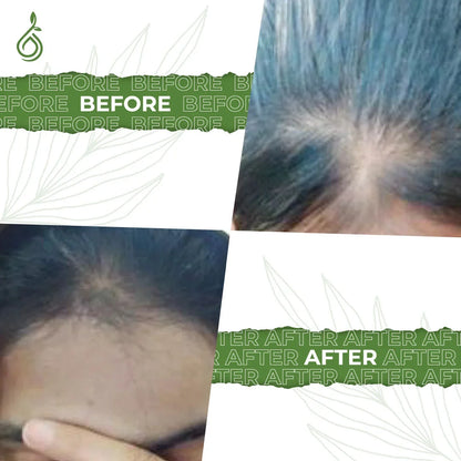 Hairfall Hairgrowth