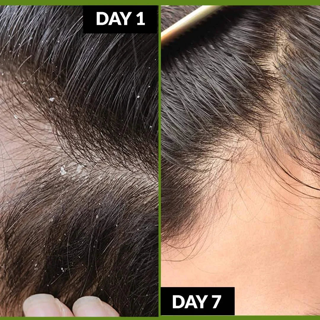 Dandruff Greasy Bundle