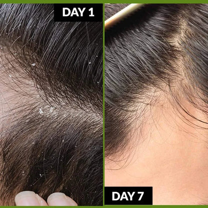 Dandruff Greasy Bundle